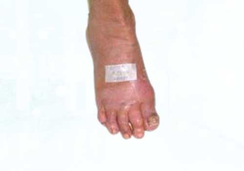 before after foot deformaties4a