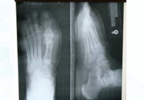 before after foot deformaties5b