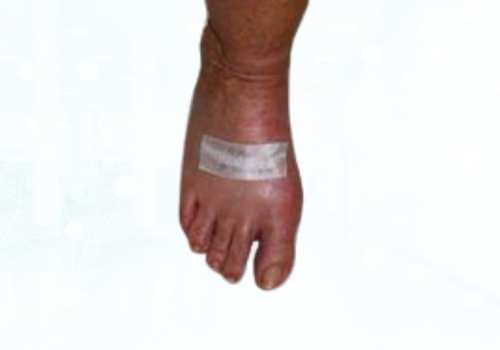 before after foot deformaties6a