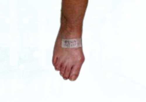 before after foot deformaties6b