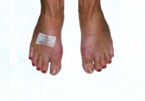 before after foot deformaties7a