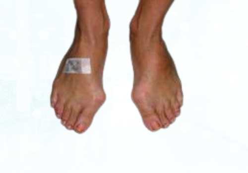 before after foot deformaties7b