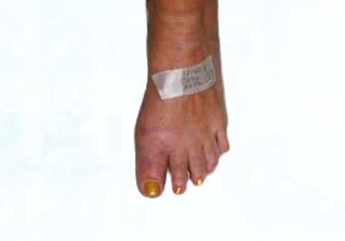before after foot deformaties8a