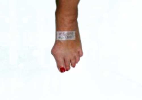 before after foot deformaties8b