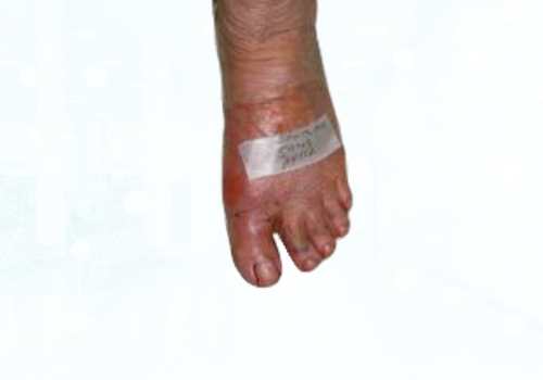 before after foot deformaties9a