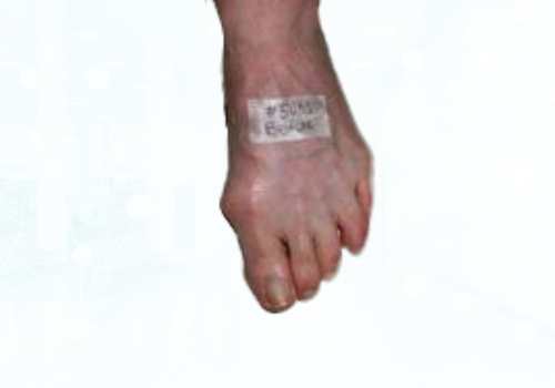 before after foot deformaties9b